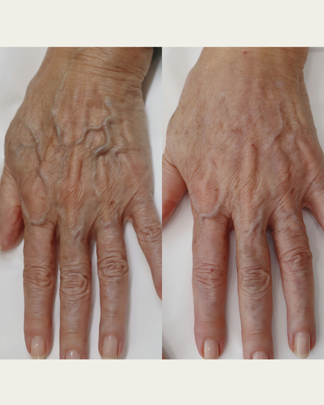 Hands and Feet Bioplasty