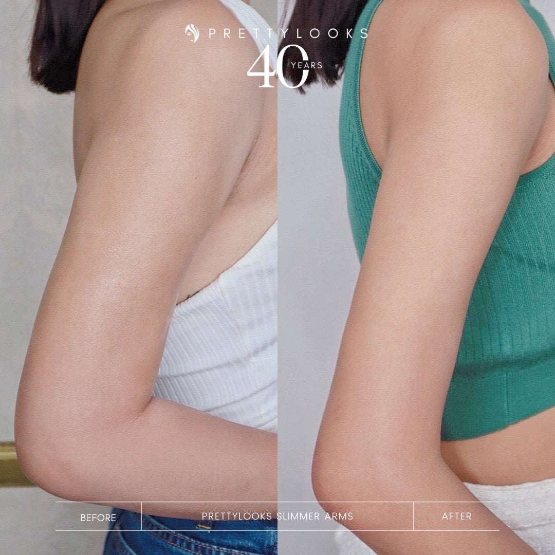 Slimmer Arms – Prettylooks Aesthetic Center