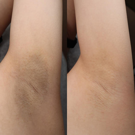 Black Pearl Underarm Treatment