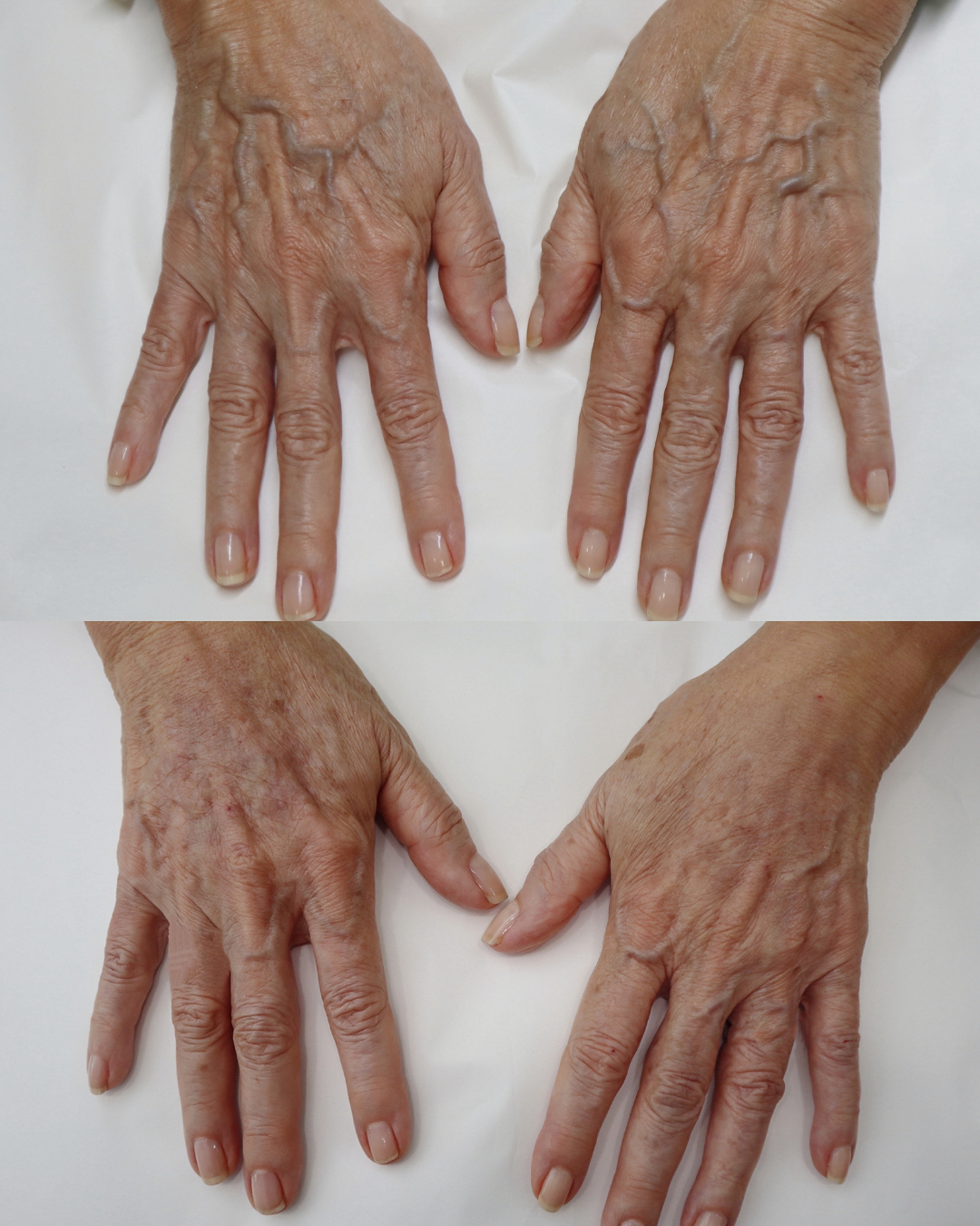 Hands and Feet Bioplasty