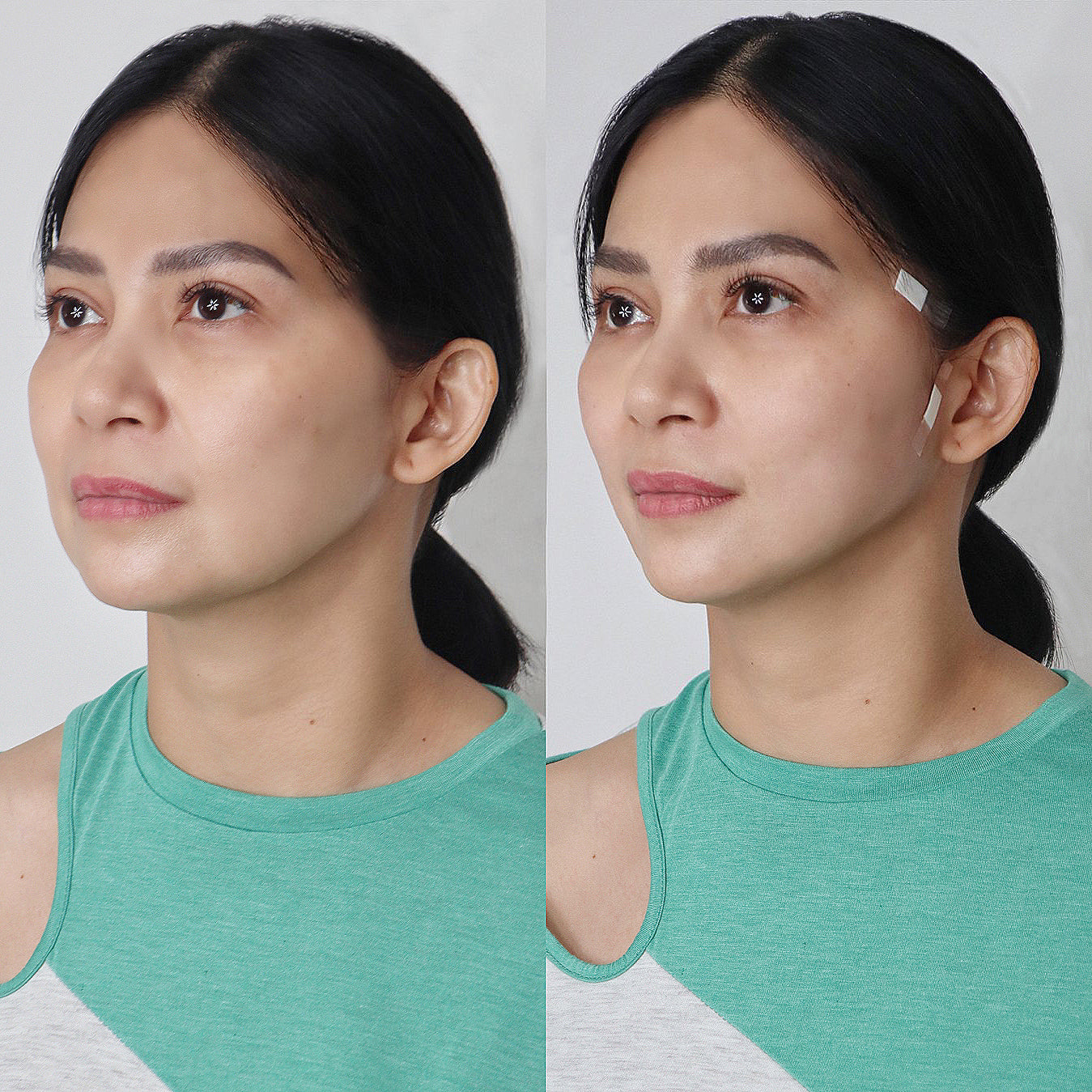 Aptos Jaw Threadlift