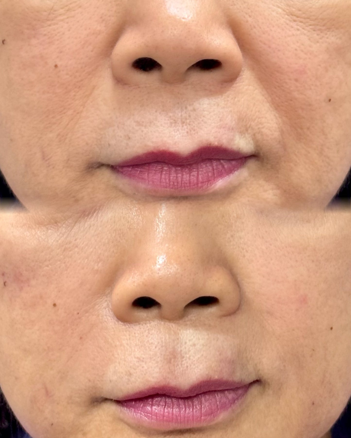 Nasolabial Fold Filler