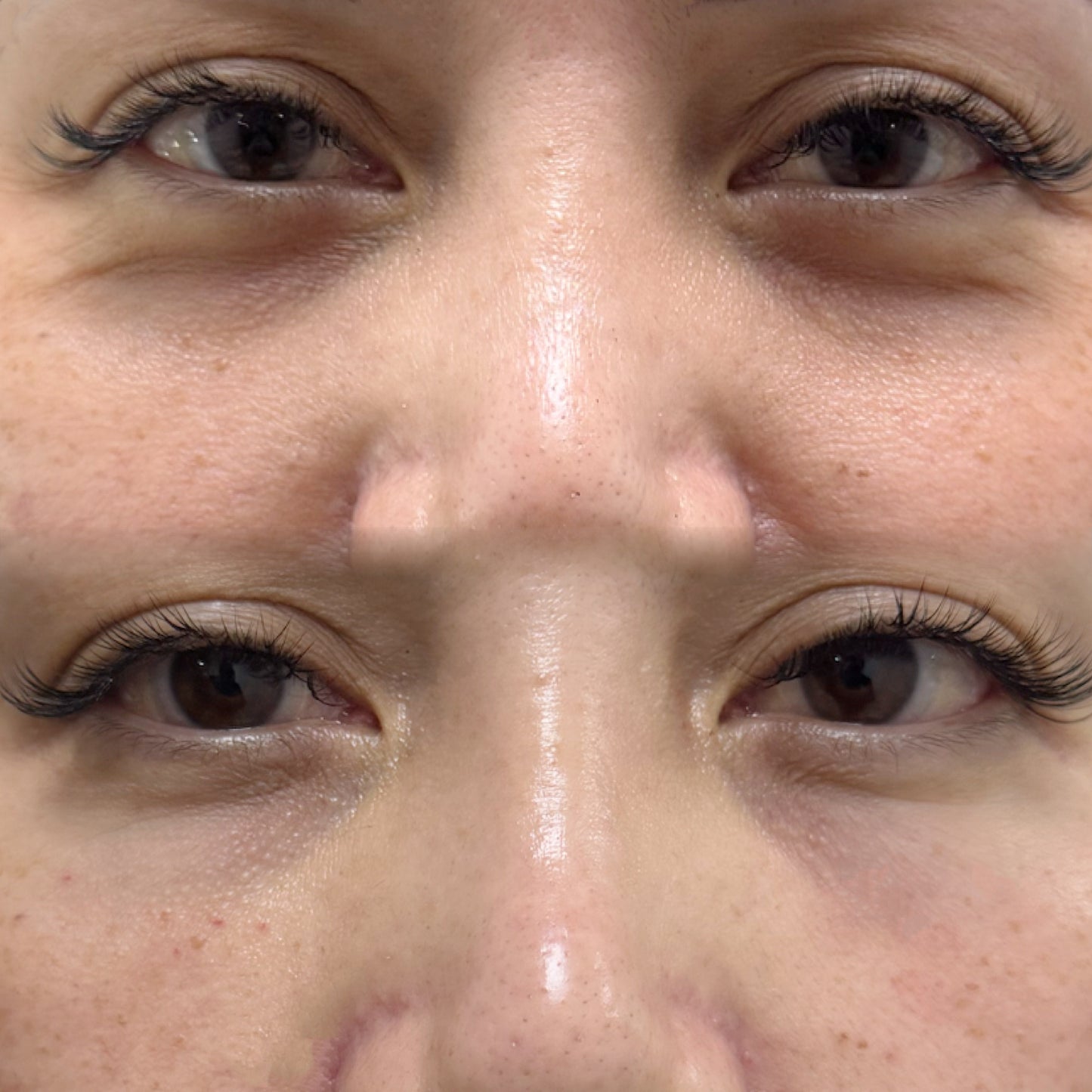 Eyebag Removal