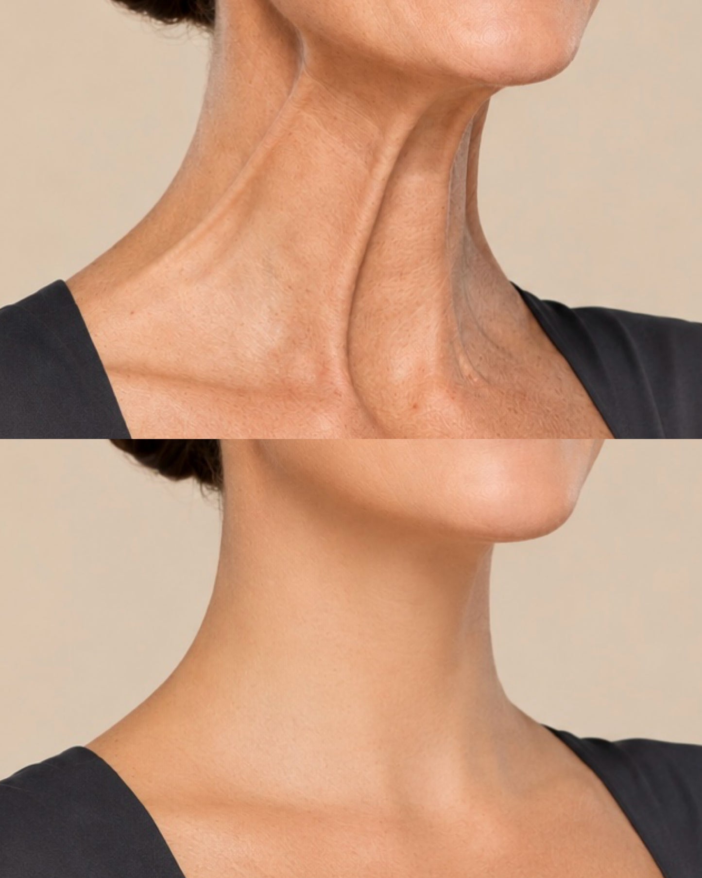 Botulin Neck Lift