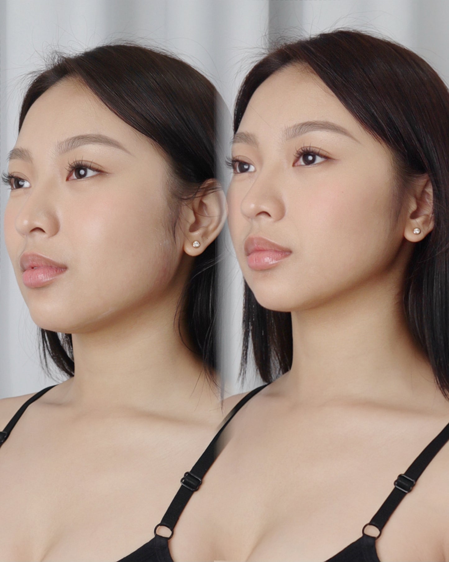 Masseter Botulin Lift & Glow