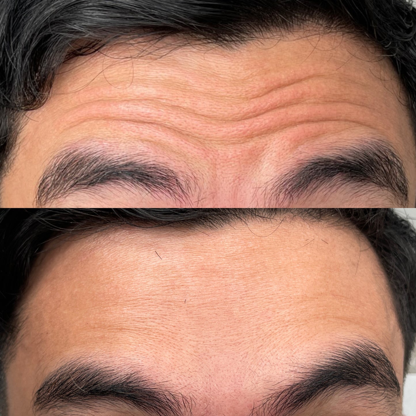 Anti-wrinkle Botulin Lift & Glow for Men