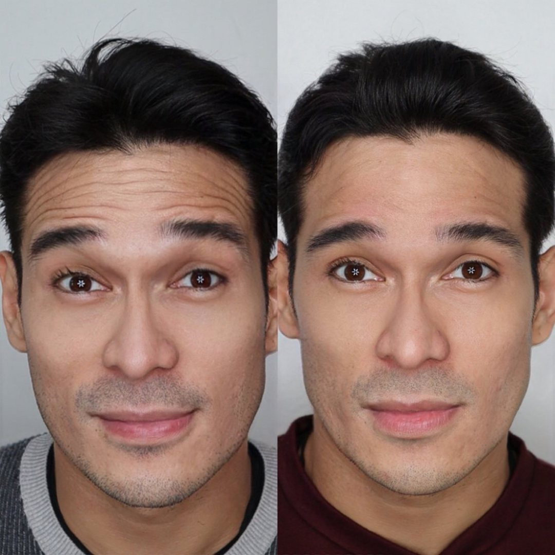 Anti-wrinkle Botulin Lift & Glow for Men