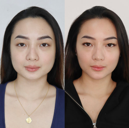 Masseter Botulin Lift & Glow