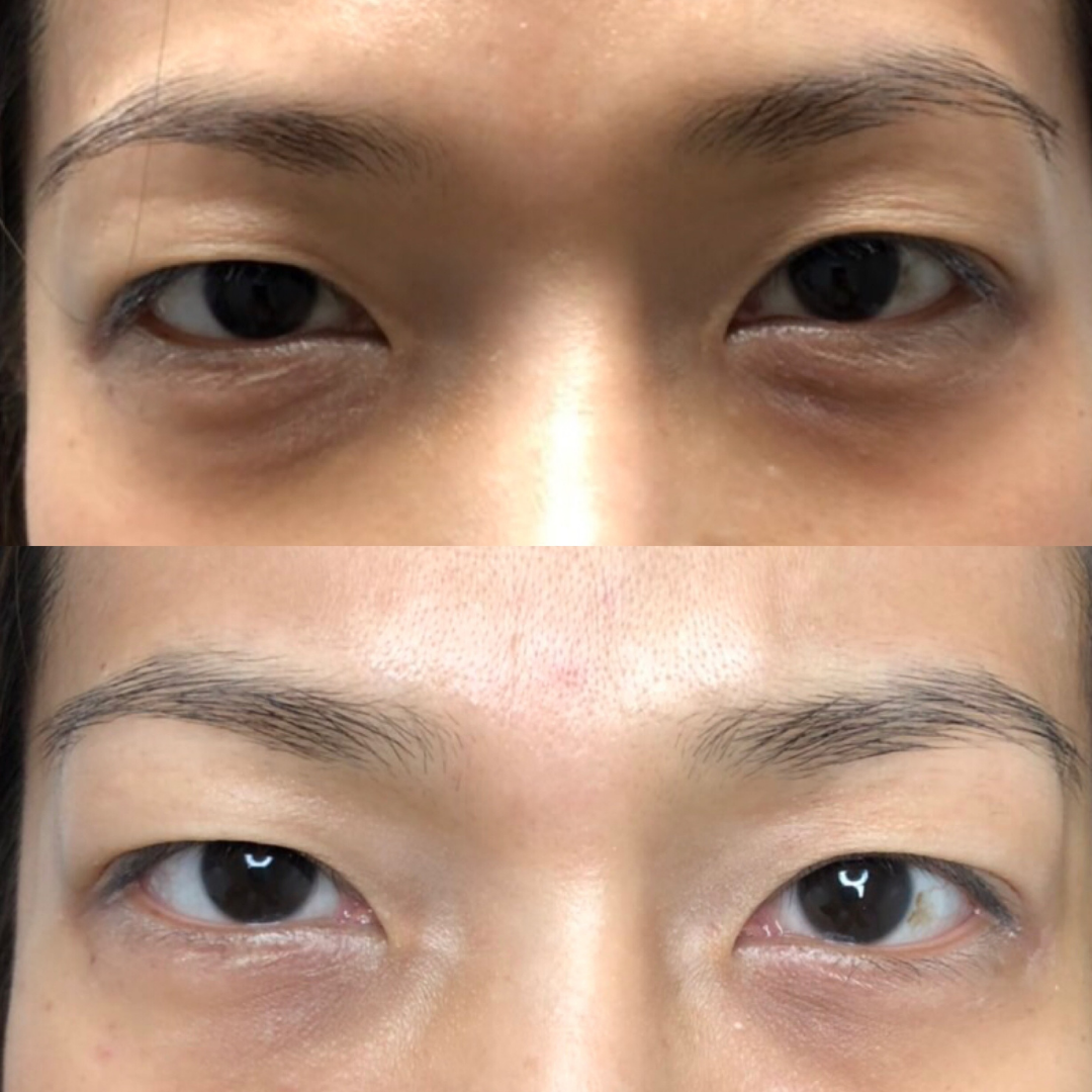 Eyebag Removal