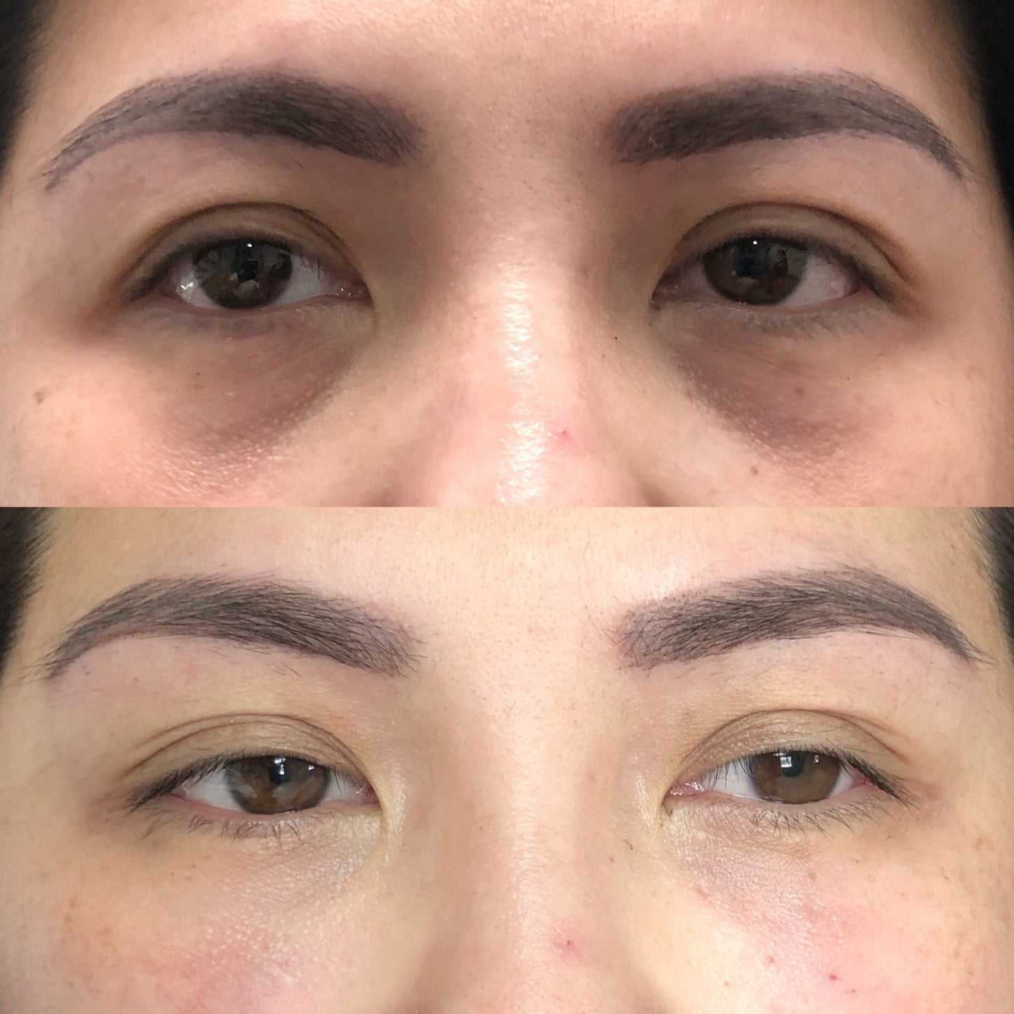 Eyebag Removal