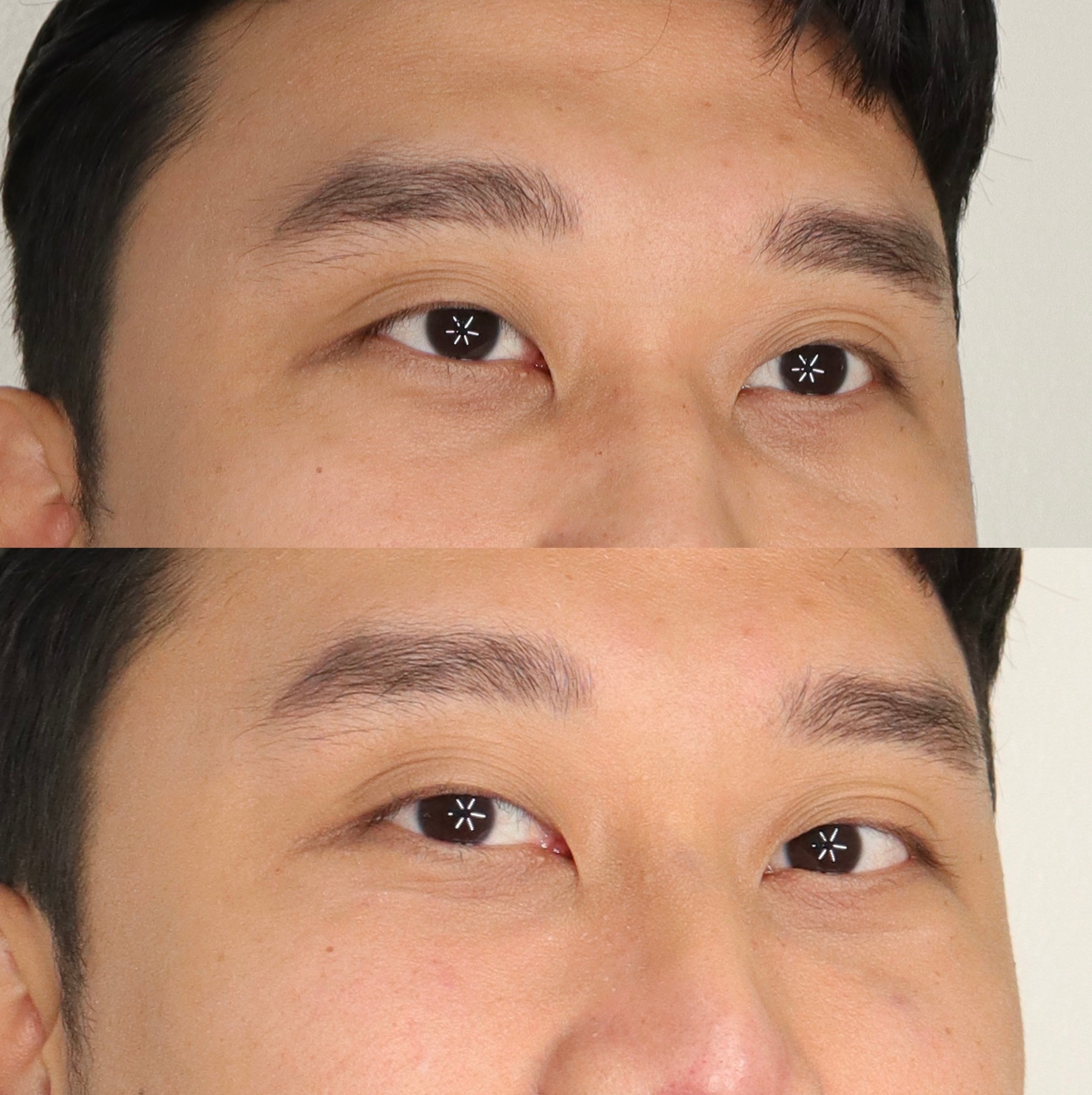 Double eyelid sale surgery cost philippines